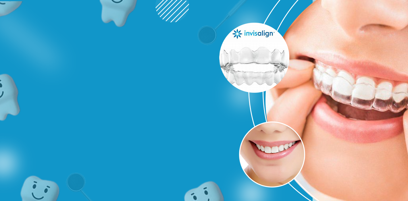 Aligners - The Choice is Clear